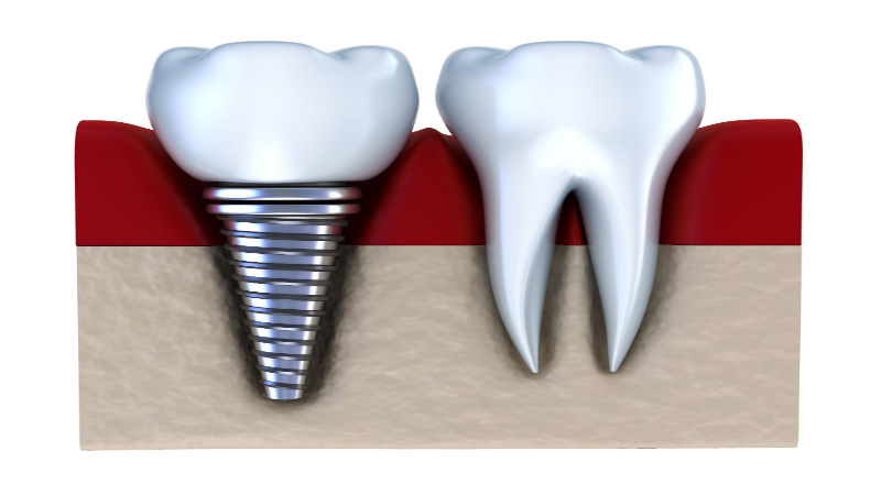 The Best Reasons Why You Should Choose Dental Teeth Implants