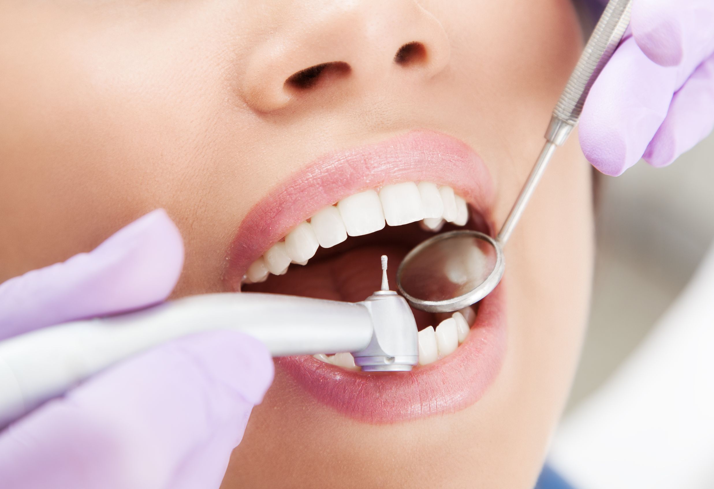 Teeth Whitening In Castle Hill: Benefits